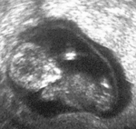 thumb_1lebenundtod-us-foetus